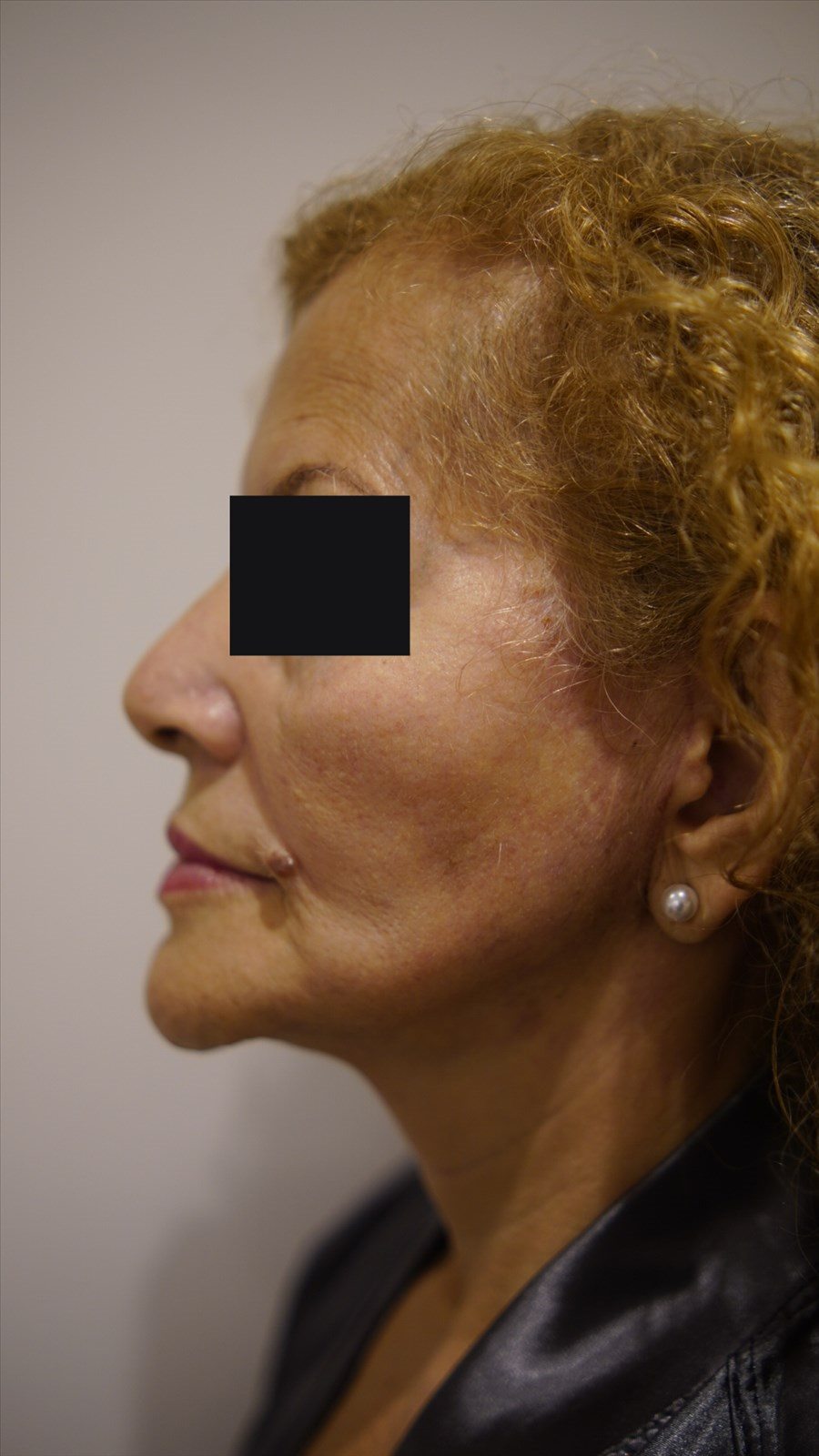 Depois da cirurgia