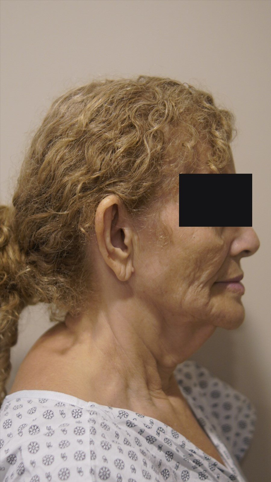 Antes da cirurgia