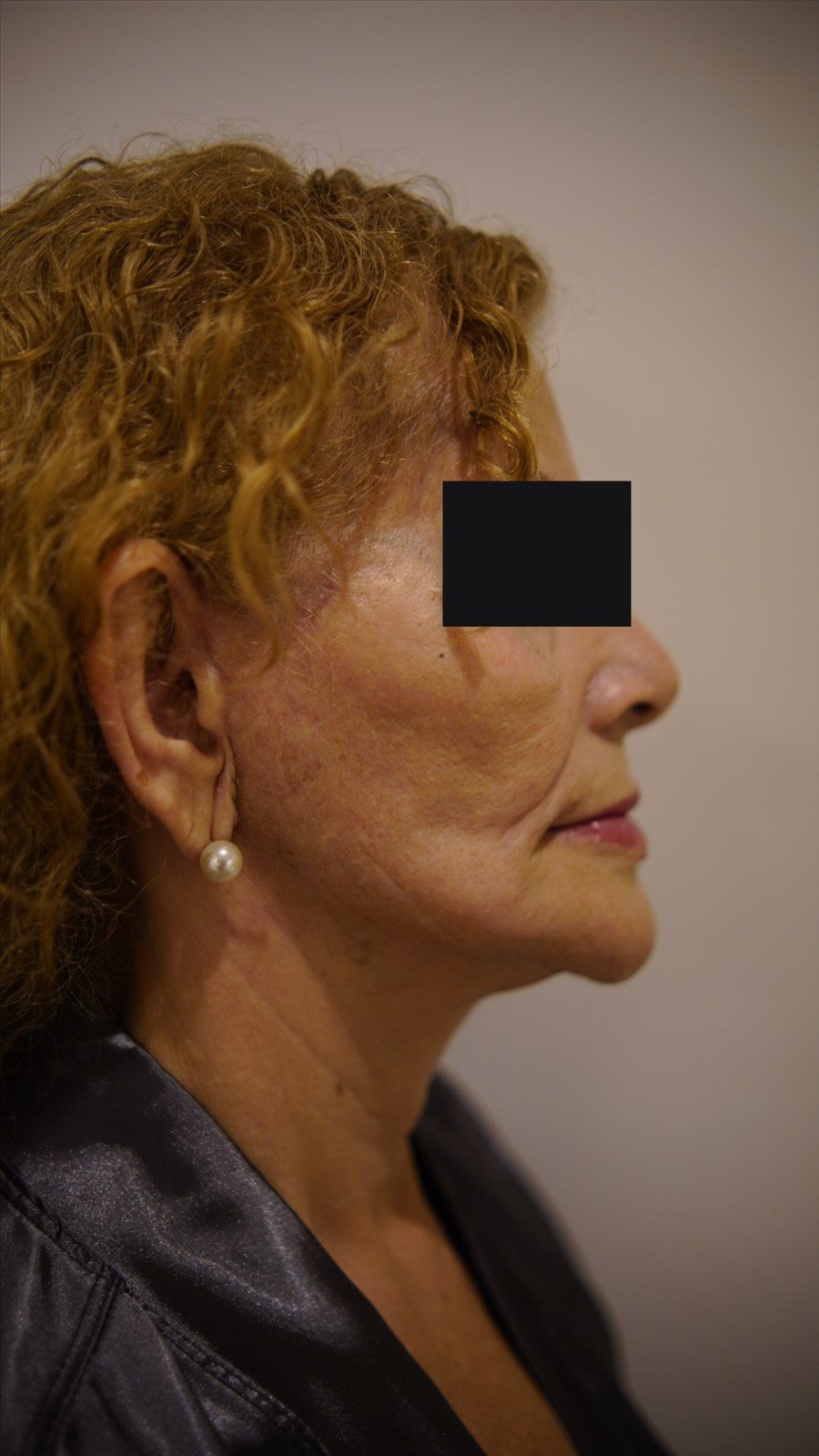 Depois da cirurgia