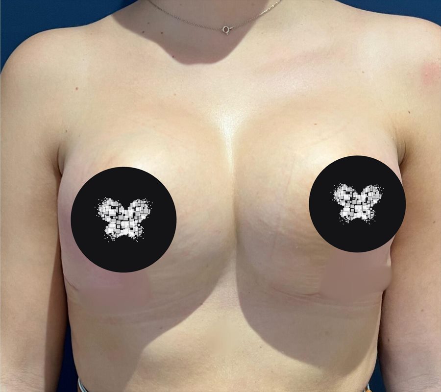 Depois da cirurgia